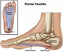 Fascitis plantar: La sombra del corredor