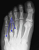 Les fractures per estrès