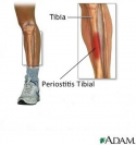 Periostitis tibial, what is this?